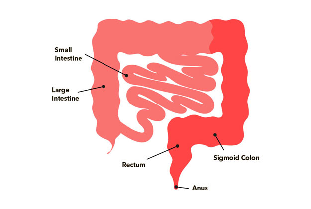 Ulcerative Colitis