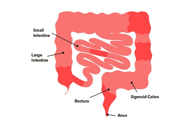 Crohnova choroba